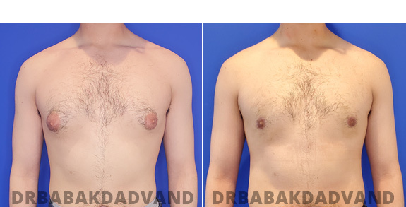 Before and After Treatment Photos - male - view (patient - 85)