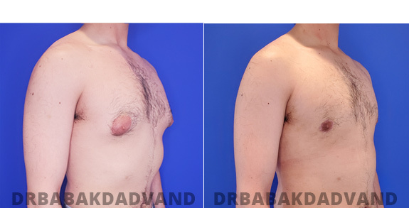 Before and After Treatment Photos - male - view (patient - 85)