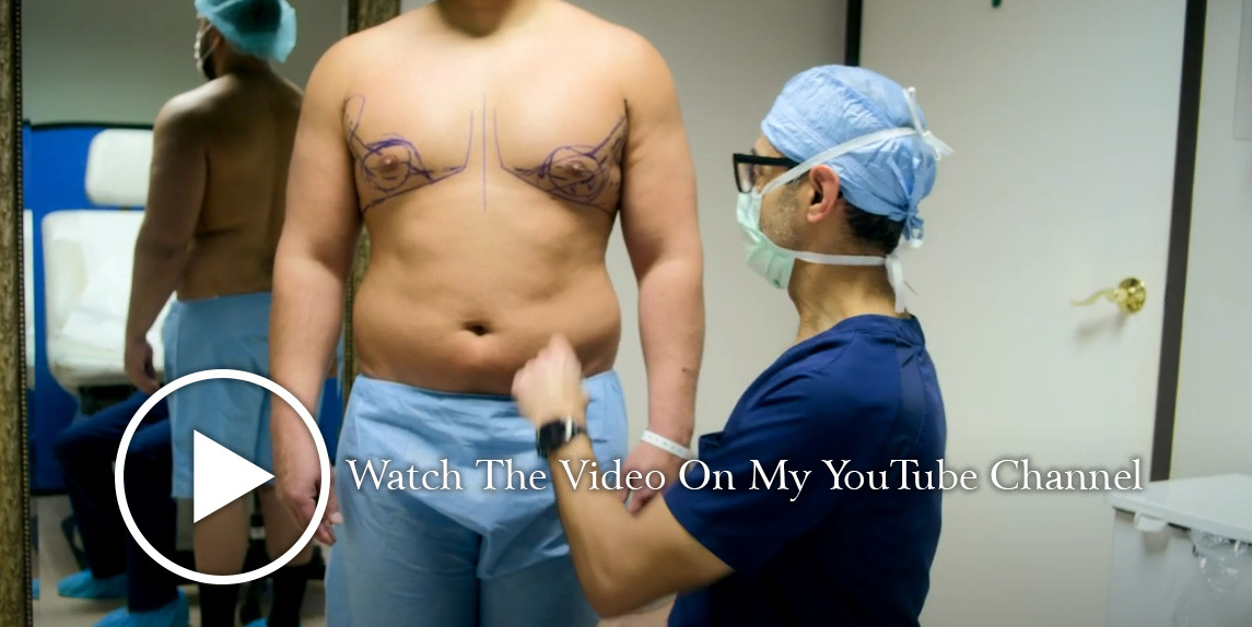 Gynecomastia