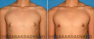 Male Breast Before After 2