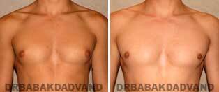 Male Breast Before After 3