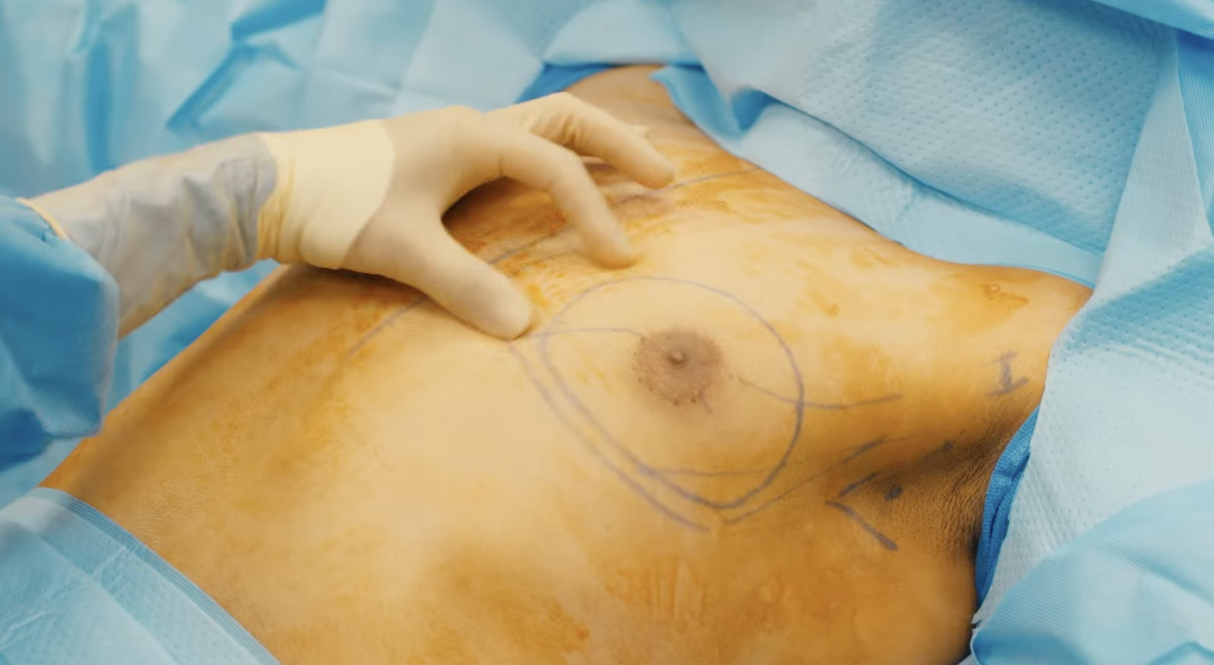 Gyno gland removal surgery procedure highlighting marked areas on chest, illustrating why gym workouts cannot fix gynecomastia.