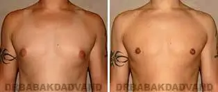 Male Breast Before After 1