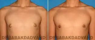 Male Breast Before After 2